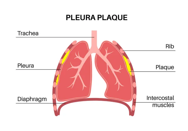胸膜斑块医疗海报 与石棉有关的肺部疾病 人体组织变厚 呼吸系统疾病 呼吸困难 胸痛扁平法说明 — 图库矢量图片