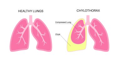 Chylothorax hastalığı. Akciğerlerdeki doku katmanları ve göğüs duvarı arasında lenfatik sıvı var. Şiddetli öksürük, göğüs ağrısı, nefes darlığı. Sağlıksız iç organlar. Solunum sistemi vektör çizimi