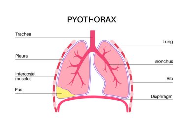 Pyothorax ve plevral empyema. Ciğerleri iltihaplanmış. Göğüs boşluğu ve kalp bölgesinde enfeksiyon. Göğüs ağrısı, nefes darlığı. Sağlıksız iç organ. Solunum sisteminde iltihap ya da bakteri