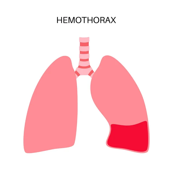 Doença Hemotórax Sangue Recolhe Cavidade Pleural Colapso Pulmonar Falha Desordem — Vetor de Stock