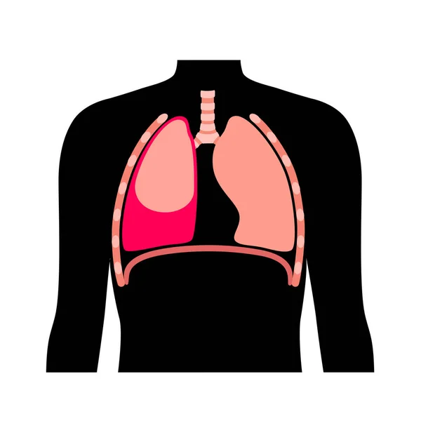Malattia Dell Emotorace Sangue Raccoglie Nella Cavità Pleurica Collasso Polmonare — Vettoriale Stock