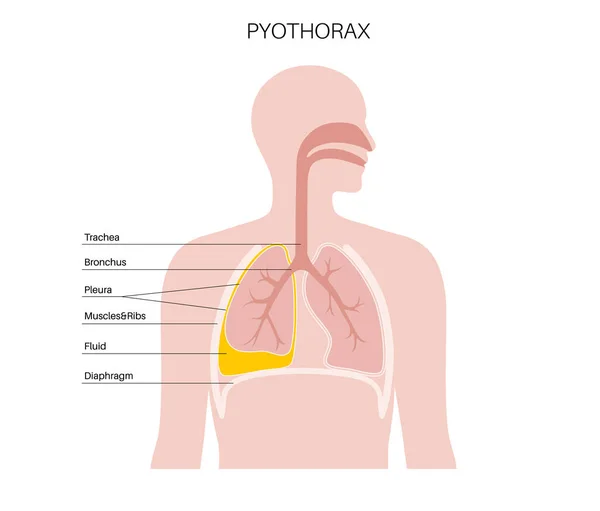 Piotórax Empiema Pleural Doença Inflamatória Dos Pulmões Infecção Cavidade Torácica — Vetor de Stock