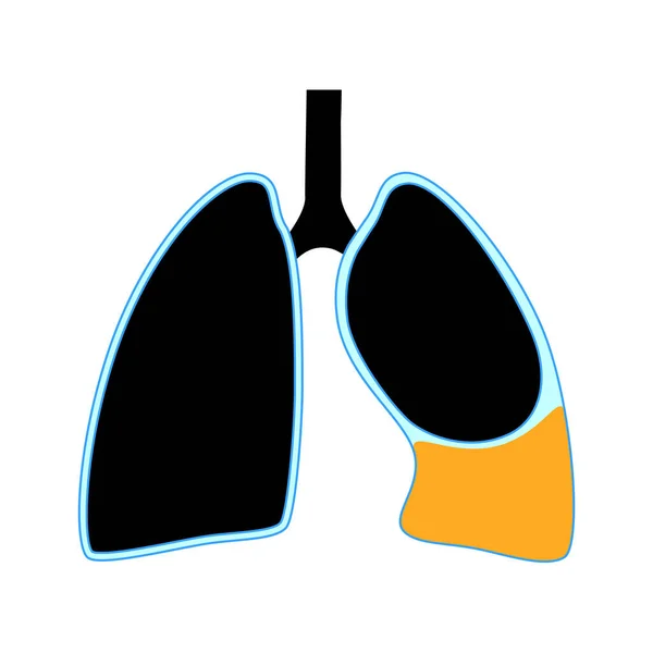 Chylothorax Hastalığı Akciğerlerdeki Doku Katmanları Göğüs Duvarı Arasında Lenfatik Sıvı — Stok Vektör