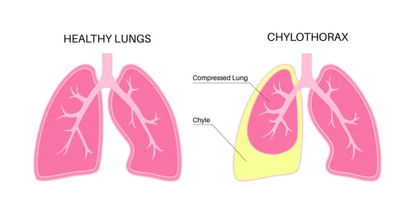 チロソラックス病 肺および胸壁の組織の層間のリンパ液 重度の咳 呼吸困難 不健康な内臓だ 呼吸器系ベクトル図 — ストックベクタ