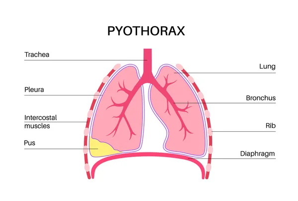 Pyothorax Und Pleuralempyem Lungenentzündung Infektion Brust Und Herzbereich Brustschmerzen Atemnot — Stockvektor