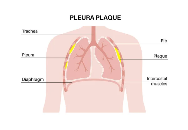 Pleuraplaque Medizinisches Plakat Asbestbedingte Lungenerkrankungen Verdicktes Gewebe Menschlichen Körper Erkrankungen — Stockvektor