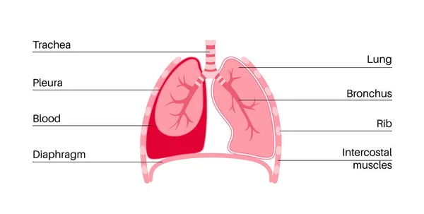 Hämothorax Erkrankung Das Blut Sammelt Sich Der Pleurahöhle Lungenkollaps Versagen — Stockvektor