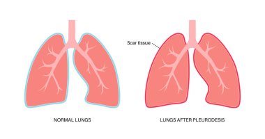 Kimyasal pleurodesis tıbbi poster. Kötü huylu plevral efüzyonları plevral boşluğa kimyasal madde enjekte ederek tedavi ediyor. Plevral uzayda yara dokusu. Akciğer hastalıkları düz vektör çizimi