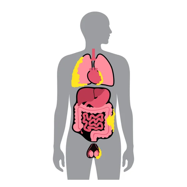 Types Tumeur Mésothéliome Cellules Cancéreuses Propageant Dans Les Poumons Cœur — Image vectorielle