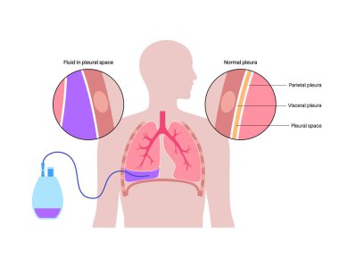Tunneled pleural catheter system. Ambulatory pleural drainage concept. Managing of shortness of breath from recurrent malignant pleural effusions Tube drain in compressed or collapsed lung flat vector clipart