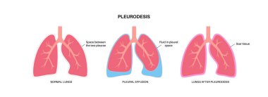 Kimyasal pleurodesis tıbbi poster. Kötü huylu plevral efüzyonları plevral boşluğa kimyasal madde enjekte ederek tedavi ediyor. Plevral uzayda yara dokusu. Akciğer hastalıkları düz vektör çizimi