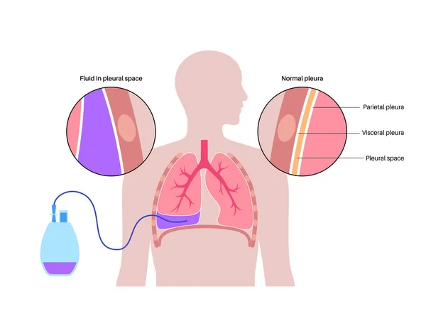 导管型胸壁导管系统 胸腔内引流的概念 压缩或塌陷肺平面载体中循环恶性胸腔积液呼吸短促的处理 — 图库矢量图片