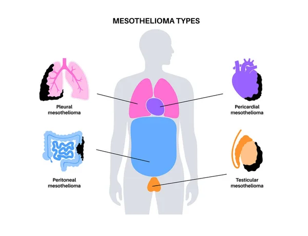 Tipos Tumor Mesotelioma Células Cancerosas Diseminadas Pulmón Corazón Intestino Testículos — Vector de stock