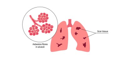 Asbestosis anatomik poster. Akciğer hastalığı konsepti, asbest lifleri. Akciğer dokusu yaralanması, nefes darlığı, göğüs ağrısı. Solunum problemi, solunum sistemi vektör çizimi hastalığı.