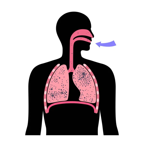 Zapalenie Płuc Azbest Krzemień Choroba Pracowników Węgla Cwp Lub Choroby — Wektor stockowy