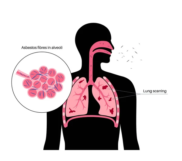 解剖学的ポスター 肺疾患の概念 アスベストス繊維 肺組織の瘢痕化と息切れ 胸の痛み 呼吸器系のベクトル図の病気 — ストックベクタ