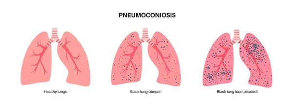 Begreppet Kolarbetare Sjukdom Pneumokonios Medicinsk Affisch Cwp Eller Svart Lungsjukdom — Stock vektor