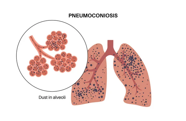 Zapalenie Płuc Azbest Krzemień Choroba Pracowników Węgla Cwp Lub Choroby — Wektor stockowy