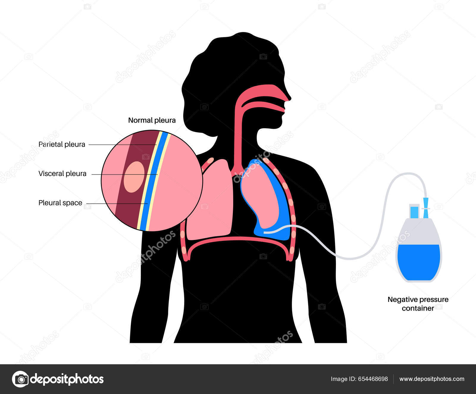 Tunneled pleural catheter system ambulatory pleural drainage concept