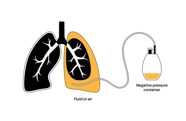 トンネル胸膜カテーテルシステム 吸水性の胸水の概念 再発悪性胸水からの息切れの管理圧縮または崩壊した肺フラットベクトル中の管排水 — ストックベクタ
