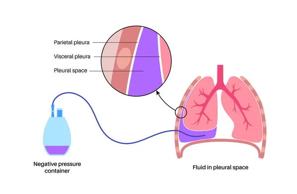 トンネル胸膜カテーテルシステム 吸水性の胸水の概念 再発悪性胸水からの息切れの管理圧縮または崩壊した肺フラットベクトル中の管排水 — ストックベクタ