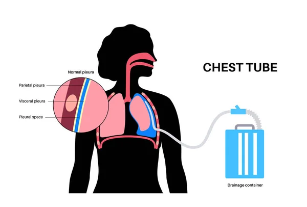 胸部チューブまたは胸部カテーテルの概念 チューブ胸水は 圧縮または崩壊肺から流体または空気を排出します プラスまたは胸膜の空間で血 不健康な臓器呼吸器系疾患フラットベクトル — ストックベクタ