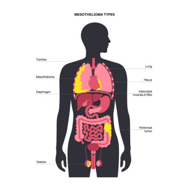 Types of mesothelioma tumor. Cancer cells spreading in lung, heart, intestine and testicles. Pleural, pericardial, peritoneal and testicular mesothelioma. Asbestos related diseases vector illustration clipart
