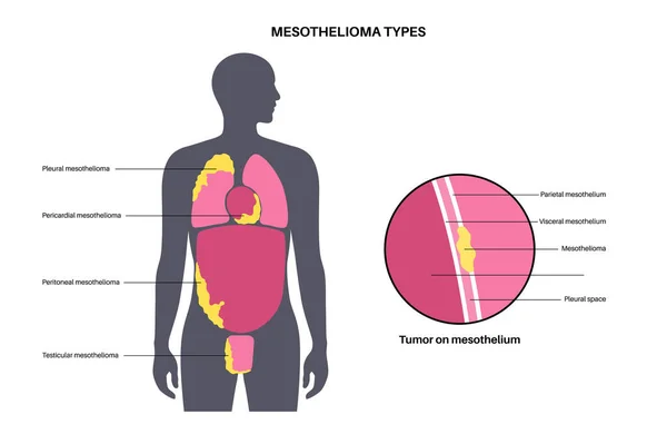 Tipos Tumor Mesotelioma Células Cancerosas Diseminadas Pulmón Corazón Intestino Testículos — Archivo Imágenes Vectoriales