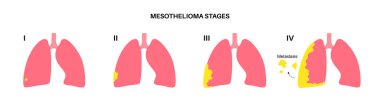Akciğer kanseri aşamaları, mezotelyom tümör hücreleri yayılıyor. Solunum sistemi hastalığı. Asbest kaynaklı hastalıklar. Nefes darlığı, göğüs ağrısı, solunum problemi, tıbbi düz vektör çizimi.