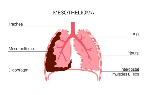 Poster Sulle Cellule Tumorali Del Mesotelioma Concetto Cancro Polmoni Malattia — Vettoriale Stock