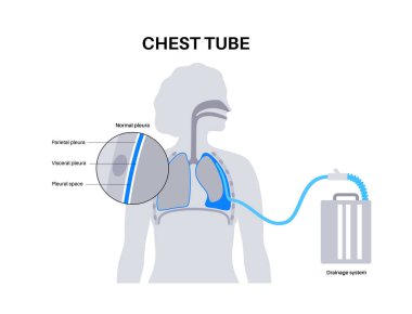 Chest tube or thoracic catheter concept. Tube thoracostomy drain fluid or air from compressed or collapsed lung. Pus or blood in pleural space. Unhealthy organ, respiratory system disease flat vector clipart