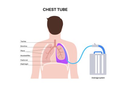 Chest tube or thoracic catheter concept. Tube thoracostomy drain fluid or air from compressed or collapsed lung. Pus or blood in pleural space. Unhealthy organ, respiratory system disease flat vector clipart