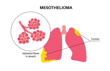 Mesothelioma tumor cells poster. Lung cancer concept. Respiratory system illness. Asbestos related diseases. Shortness of breath, pain in chest, breathing problem, medical flat vector illustration. clipart