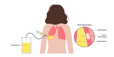 Thoracentesis procedure medical poster. Obtain fluid from space around the compressed lung. Incision of the chest wall. Unhealthy internal organs, respiratory system disease flat vector illustration clipart