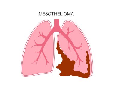 Mesothelioma tumor cells poster. Lung cancer concept. Respiratory system illness. Asbestos related diseases. Shortness of breath, pain in chest, breathing problem, medical flat vector illustration. clipart