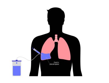 Torasentez prosedürü tıbbi posteri. Sıkıştırılmış akciğerin etrafından sıvı al. Göğüs duvarında kesik var. Sağlıksız iç organlar, solunum sistemi hastalığı düz vektör çizimi