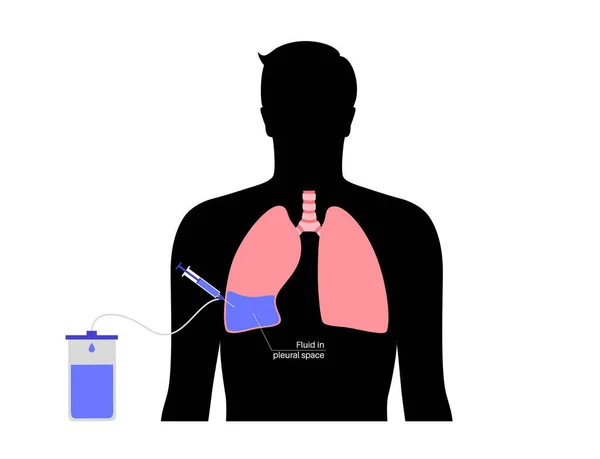 Thoracentèse Procédure Affiche Médicale Obtenir Liquide Espace Autour Poumon Comprimé — Image vectorielle