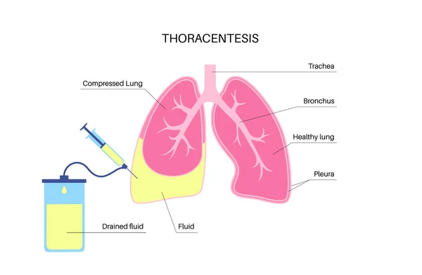 Процедура Торакентеса Медичний Плакат Отримати Рідину Космосу Навколо Стиснутої Легені — стоковий вектор