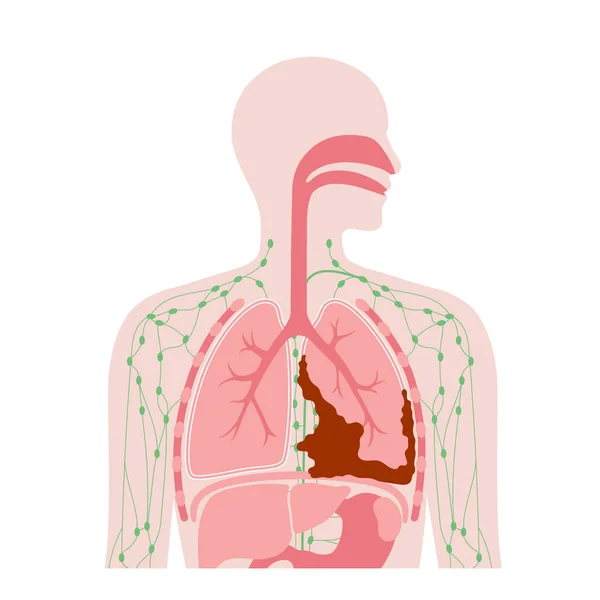 Mesoteliom Tumörceller Affisch Lungcancerkonceptet Sjukdom Andningsorganen Asbestrelaterade Sjukdomar Andfåddhet Bröstsmärta — Stock vektor