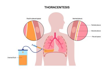 Thoracentesis procedure medical poster. Obtain fluid from space around the compressed lung. Incision of the chest wall. Unhealthy internal organs, respiratory system disease flat vector illustration clipart