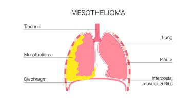 Mezotelyom tümör hücreleri posteri. Akciğer kanseri konsepti. Solunum sistemi hastalığı. Asbest kaynaklı hastalıklar. Nefes darlığı, göğüs ağrısı, solunum problemi, tıbbi düz vektör çizimi.