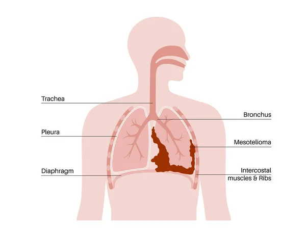 Plakat Komórek Nowotworowych Mesothelioma Koncepcja Raka Płuc Choroby Układu Oddechowego — Wektor stockowy