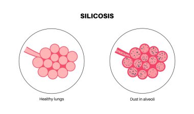 Silikozis anatomik poster. Akciğer hastalığı, yüksek miktarda kristal silis tozu soluyor. Nefes darlığı, göğüs ağrısı. Solunum problemi, solunum sistemi vektör çizimi hastalığı.