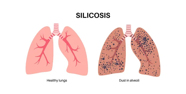 珪肺解剖ポスター 肺疾患 結晶性シリカダストの大量の吸入 息切れ 胸の痛み 呼吸器系のベクトル図の病気 — ストックベクタ