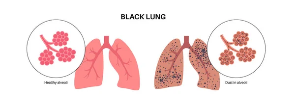 stock vector Coal workers disease concept, pneumoconiosis medical poster. CWP or black lung occupational illness, coal mine dust in the respiratory system. Shortness of breath, chest pain flat vector illustration.