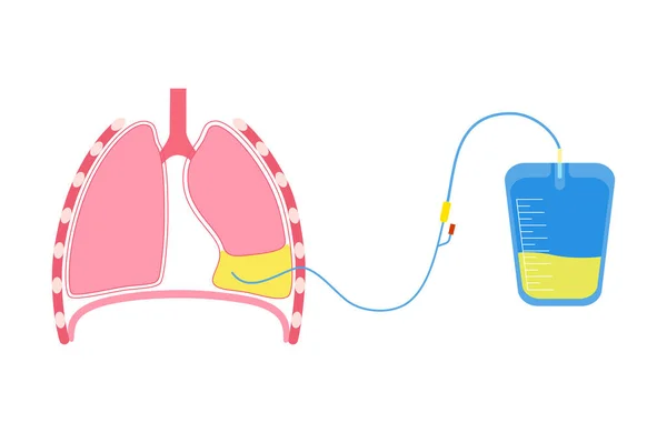 人工授精の手順医学ポスター 圧縮肺の周りの空間から流体を取得します 胸壁の切開 不健康な内臓 呼吸器系疾患フラットベクトル図 — ストックベクタ