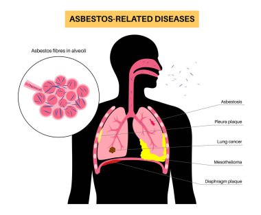 Asbestos related diseases. Pleura and diaphragm plaque, lung cancer, asbestosis, and mesothelioma tumor cells. Respiratory system illness. Shortness of breath, pain in chest flat vector illustration. clipart