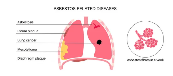 Asbestrelaterade Sjukdomar Pleura Och Membran Plack Lungcancer Asbestos Och Mesoteliom — Stock vektor