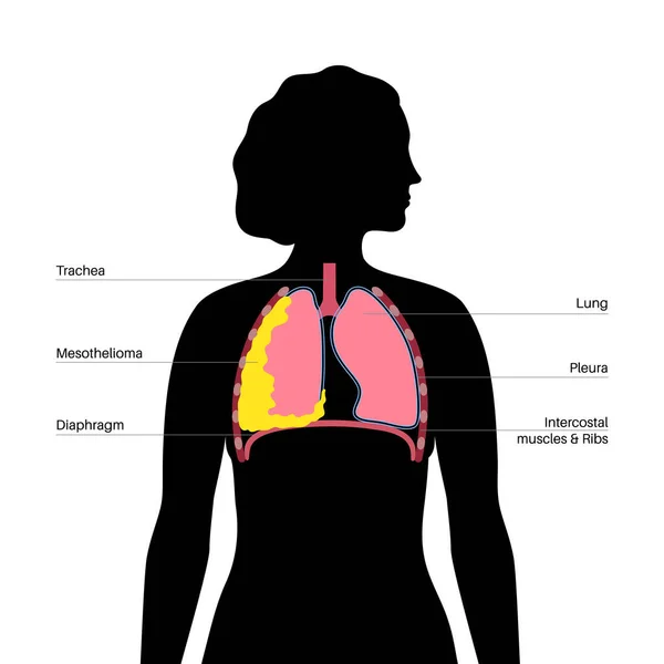 Cartaz Células Tumorais Mesotelioma Conceito Cancro Pulmão Doenças Respiratórias Doenças — Vetor de Stock