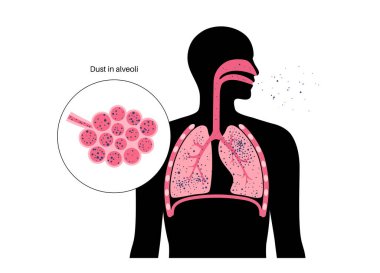 Pnömokonyoz, asbestoz ve silikoz. Kömür işçileri hastalığı, CWP veya kara akciğer mesleki hastalığı, solunum sisteminde kömür madeni tozu veya asbest. Nefes darlığı, göğüs ağrısı vektörü